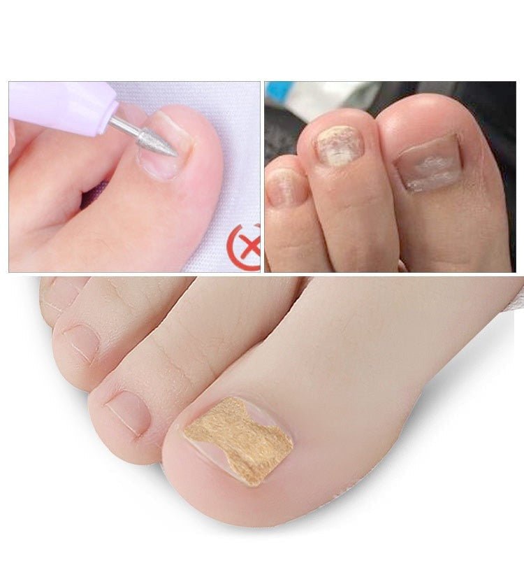 PAINLESS TOENAIL PATCH - TOENAILEXPRESS™